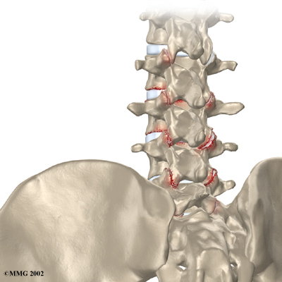 Deg-Arthritis-Facet