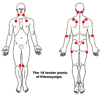 Fibromyalgia_tender_points_